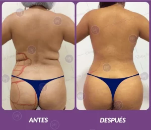 Lipotransferencia 1